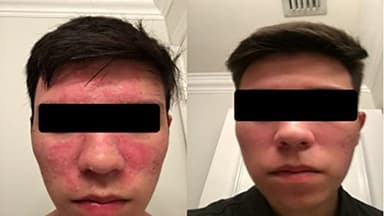 Seborrheic Dermatitis Face Cream - Skin Rejuvenation and Barrier Repair with MCT Oil, Squalane - Moisturizing Face, Scalp and Body Cream for Sensitive Skin Seb Derm - No Steroids for Lasting Results - Image 7