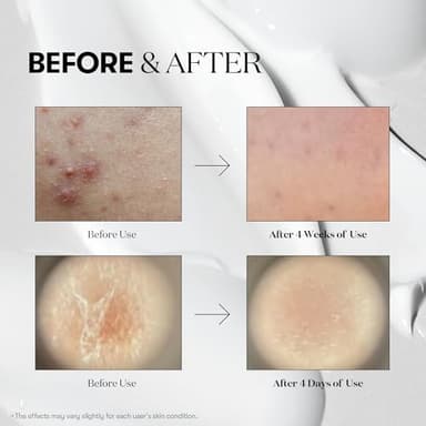 VT COSMETICS CICA Reedle Shot 700, Spicule Microneedling Serum for Pore Care&Exfoliation, Exosome&Centella Asiatica for Glass Skin, Acne&Blemish Care, Korean Liquid Skin Booster (1 Fl Oz / 30ml) - Image 5