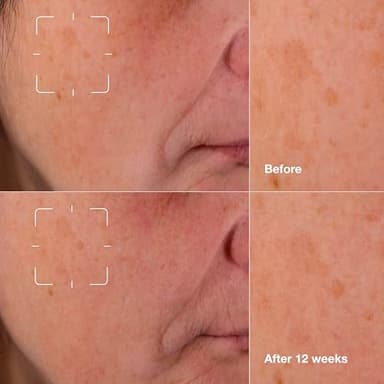 Clinique Even Better Clinical Dark Spot Clearing Vitamin C Face Serum For All Skin Types | Brightening + Soothing, 1 Fl Oz - Image 3