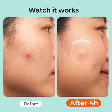 TKTK 443 Count Pimple Patches for Face, Hydrocolloid Acne Patch Bulk, Acne Stickers for Covering Cheeks, Forehead, Chin Blemishes Zit Breakouts for All Skin Types (Dots, Strip, Contoured 5 Sizes) - Image 6
