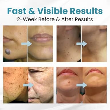 Bikenda Pen Kit,Smoothes Skin and Reduces Skin Blemishes (1 PCS) - Image 4