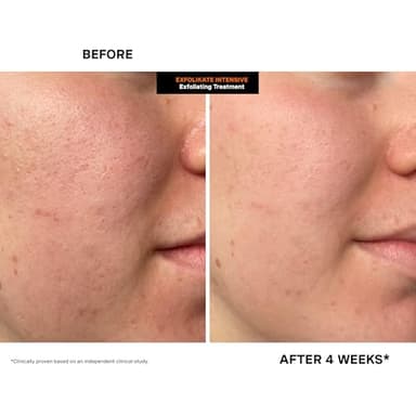 Kate Somerville ExfoliKate Intensive Exfoliating Treatment – Salicylic Acid and Lactic Acid Super Facial Scrub and Mask, Improves Texture and Pores, 0.5 Fl Oz - Image 5