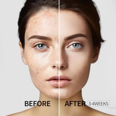 HANYWIL Dark Spot Remover for Face and Body, Dark Spot Corrector Serum, Age Spot Sun Spot Freckles Brown Spot Remover, Melasma Treatment, Skin Care Face Serum with Roller (0.5 Fl Oz) - Image 4