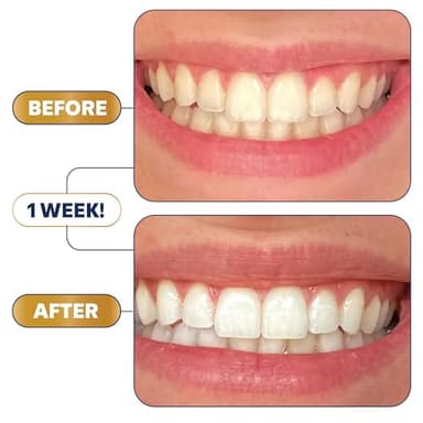 Lumineux Teeth Whitening Strips 21 Treatments – Peroxide Free - Enamel Safe for Whiter Teeth - Whitening Without The Sensitivity - Dentist Formulated - Sensitivity - Image 3