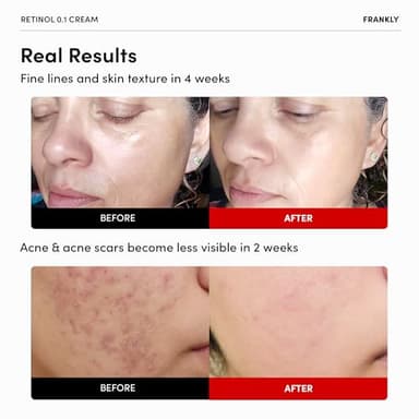 FRANKLY Retinol 0.3% Cream, 0.7 fl oz - Intensive Retinol | Night Cream | Retinol, Ceramides & Natural Ginseng | Anti-aging, Wrinkles Care, Reduces Congestion and hyperpigmentation | Korean Skin Care - Image 2