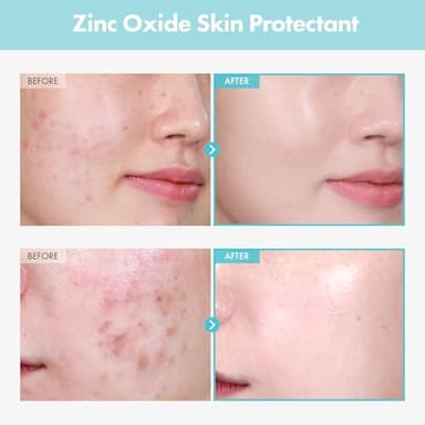 TOSOWOONG SOS Repair CICA Clinic Zinc Cream, 100,000ppm Zinc Oxide, Heal, Soothe Acne, Redness, Rosacea Treatment, Skin Barrier Repair, Moisture, Non-Comedogenic, Korean Skincare, 50g, 1.76 oz. - Image 2