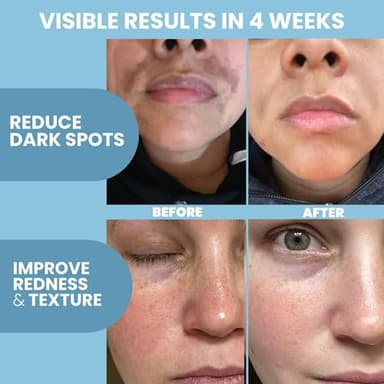 Eva Naturals Azelaic Acid Serum for Face – Niacinamide, Hyaluronic Acid, Vitamins A+C+E – Redness Relief, Dark Spots, Uneven Skin Tone, Texture, Pores, Topical Booster for Clearer, Smoother Skin, 2oz - Image 4