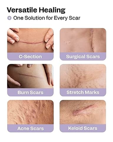 AWD Silicone Scar Sheets for Surgical Scars - Seamless Medical Grade Silicone Scar Tape for C Section, Tummy Tuck Tape - Silicone Skin Patches After Surgery Must Haves (1.6" x 60" Seamless Roll) - Image 4