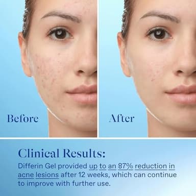 Differin Acne Treatment Gel, 60 Day Supply, Retinoid Treatment for Face with 0.1% Adapalene, Gentle Skin Care for Acne Prone Sensitive Skin, 15g Tube (Pack of 2) (Packaging May Vary) - Image 8