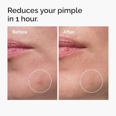 The Ordinary Sulfur 10% Powder-to-Cream Acne Spot Treatment Concentrate, Reduces Pimple Size and Zit Redness, 0.18 Oz - Image 2