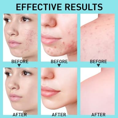 Acne Pimple Spot Treatment Cream: Cystic Hormonal Blackheads Blemish Breakouts for Face, Back and Body - 10% Azelaic Acid & Salicylic Acid - Teens-Adults, 1.8 oz - Image 3