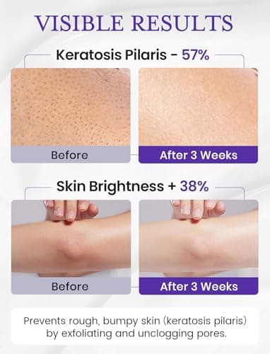 Elvira KP Bump Eraser Foot & Body Scrub, Exfoliating Scrub for Keratosis Pilaris, Smooth Skin with 10% AHA BHA & Niacinamide, Deep Moisturizing Cleanser for All Skin Types, Exfoliante para el Cuerpo - Image 6