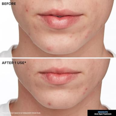 Kate Somerville EradiKate Acne Treatment - Clinically Formulated 10% Sulfur and BHA Spot Treatment – Clears Pimples, Cleans Pores and Prevents Breakouts, 1 Fl Oz - Image 9