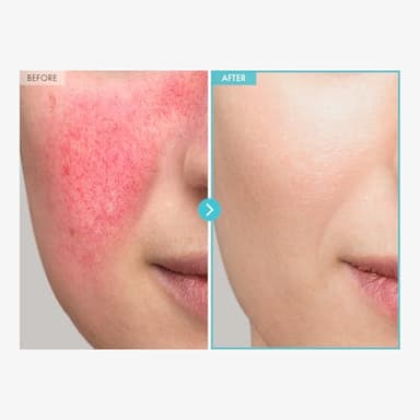 TOSOWOONG SOS Repair CICA Clinic Zinc Cream, 100,000ppm Zinc Oxide, Heal, Soothe Acne, Redness, Rosacea Treatment, Skin Barrier Repair, Moisture, Non-Comedogenic, Korean Skincare, 50g, 1.76 oz. - Image 3