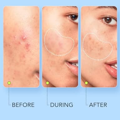 LitBear Large Pimple Patches (7 Sizes 112 Counts), Big Acne Patches, XL Hydrocolloid Bandages for Full Face, Forehead, Chin, Nose, Body, Back, Neck & Chest, Oval, Moon, Square hydrocolloid Patch - Image 4