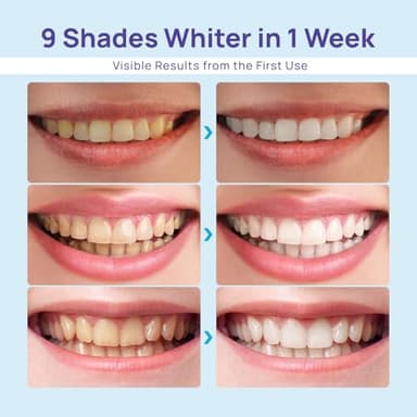 Whitebite Pro Teeth Whitening Gel Kit | Safe for Sensitive Teeth | 32X LED Light | 35% Carbamide Peroxide Whitening Gel & Remineralizing Gel | Powerful Tooth Stain Remover - Image 2
