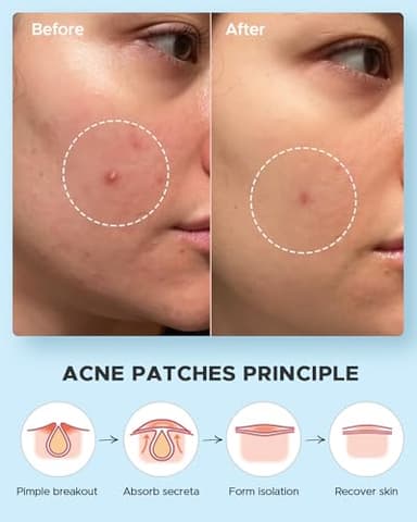 LitBear Acne Pimple Patches- Day and Night 4 Sizes 180 Dots Thin & Thick Hydrocolloid Patches with Witch Hazel, Tea Tree & Calendula Oil, Extra Adhesion for Face Zit Patch Dots - Image 6
