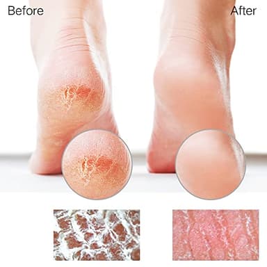 Sunivaca Glass Foot File Callus Remover for Feet, Heel Scraper, Pumice Stone, Diabetic Feet Scrubber Dead Skin Remover for Feet Professional Pedicure Tools - Image 4