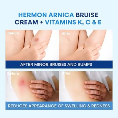 Hermon Arnica Bruise Cream Extra Strength: Fast-Acting for Bruising & Swelling on Thin Skin - High Strength Arnica Montana with Vitamins K, C & E–Hydrating Moisturizer for Face (4 oz(pack of 1)) - Image 9