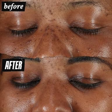 Kiehl's Clearly Corrective Dark Spot Serum, Brightening Facial Serum, Reduces Hyperpigmentation & Post-acne Marks, with Vitamin C & Salicylic Acid, All Skin Types, Paraben-free - 3.4 fl oz - Image 3