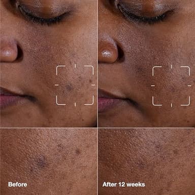 Clinique Even Better Clinical Dark Spot Clearing Vitamin C Face Serum For All Skin Types | Brightening + Soothing, 1 Fl Oz - Image 2