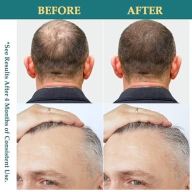 Natural Hair Growth Oil Spray: Batana Rosemary Serum Biotin Caffeine Scalp Care Treatment (2 FL OZ（Pack 1）) - Image 4