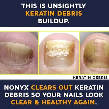 NONYX Fungal Nail Clarifying Gel | Clinically Proven for Discolored, Thick, Brittle, Yellow, Lifted, and other signs of Fungus-Damaged Toenails | 90% of Nails Improve | Over 8 million sold - Image 7