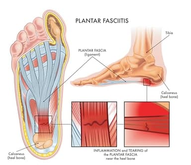 Dr. Luke Plantar Fasciitis Relief - Heel Cups for Foot Pain Relief – Heel Protectors with Thick High-Elastic Gel Pads – Women 6-12'', Men 7-11" - Image 2