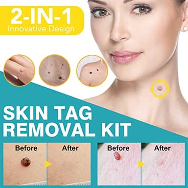 Skin Tag Remover, FDA-Cleared Skin Tag Removal Kit Device, Safe and Effective Home Use (Yellow) - Image 2