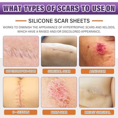 Silicone Scar Sheets,Silicone Scar Tape,Silicone Scar Removal Strips for Surgical,C-Section,Tummy Tuck,Keloid Scars (1.6"X 59" Roll-1.5M) Keloid Bump Removal - Image 2