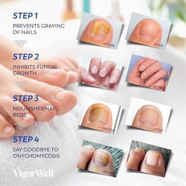 Toenail Fungus Treatment Extra Strength - (Medium) 32 Nighttime Hydrogel Patches for Overnight Toenail Repair - Visible Results in 8 Hours - Fungal Nail Patches for Toenail Fungus Relief - Image 4