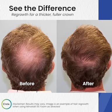 Minoxidil for Men Foam 5% - Unscented 3 Month Supply - Helps Restore Vertex Hair Loss & Thinning - 5% Minoxidil Foam For Men - Extra Strength Supports Hair Regrowth - Image 3