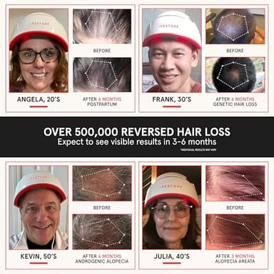 iRestore Professional Laser Red Light Therapy for Hair Growth System - FDA Cleared Hair Loss, Hair Thinning & Alopecia Treatment for Men & Women - 282 Lasers & LEDs - Image 2