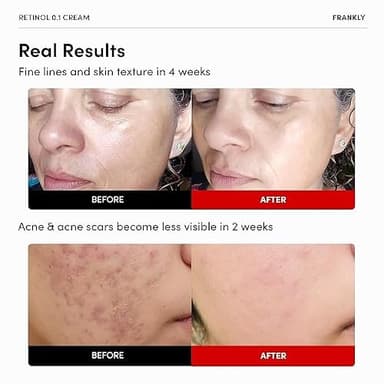 FRANKLY Retinol 0.1% Cream, 1.01 fl oz - Beginner Retinol | Night Cream | with Ceramides & Natural Ginseng | Anti-aging, Wrinkles Care, Reduces Congestion and hyperpigmentation | Korean Skin Care - Image 2