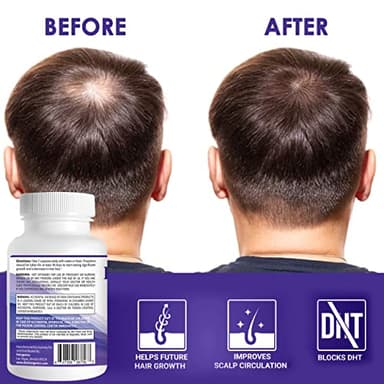Propidren by HairGenics - DHT Blocker & Hair Growth Capsules to Prevent Hair Loss & Stimulate Hair Follicles, to Stop Hair Loss & Regrow Hair. Proprietary Anti-Hair Loss & Hair Regrowth Treatment. - Image 7
