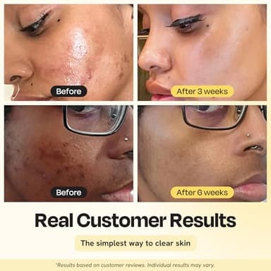 Gleamin Vitamin C Clay Mask for Dark Spots, Turmeric Clay Face Mask Skin Care, Deeply Cleanses & Refines Pores, Brightens Uneven Tone and Helps Improve Post-Blemish Scarring & Texture, Up to 20 Uses - Image 2