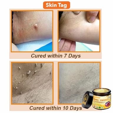 APKAPK Bee venom comprehensive Cream, Bee Venom Skin Treatment Cream,Deeply nourishes the skin and reduces skin blemishes (2PCS) - Image 3