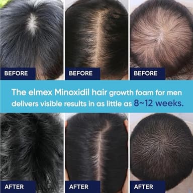 5% Minoxidil Foam for Men and Women, Minoxidil for Men Foam for Hair and Beard, Minoxidil for Women Hair Growth (2 Ounce) - Image 6