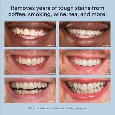 Auraglow Teeth Whitening Kit, LED Accelerator Light, 35% Carbamide Peroxide Teeth Whitening Gel, 20+ Whitening Treatments, Whitens up to 10 Shades in 7 Days - Image 6