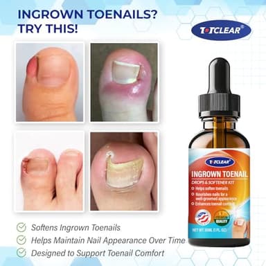 Ingrown Toenail Relief: Ingrown Toenail Tool for Men Women - Ingrown Toenail Removal Kit - Ingrown Toenail Corrector Drops - Ingrown Toenail Removal - Effective Solution for Ingrown Toenails - 30ml - Image 2