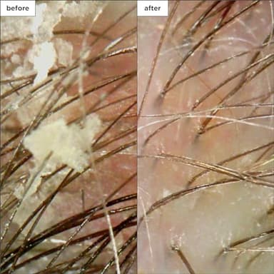 Briogeo Scalp Revival Charcoal + Coconut Oil Micro-Exfoliating Shampoo, Treatment for Dry & Itchy Scalp, Clarifying Shampoo for Build Up, Scalp Scrub for Oily Scalp, Vegan, Cruelty-Free, 8 fl oz - Image 4