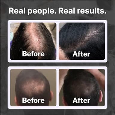 Shapiro MD Hair Growth Experts Hair Loss Shampoo | DHT Fighting Vegan Formula for Thinning Hair Developed by Dermatologists | Experience Healthier, Fuller and Thicker Looking Hair | 2 Month Supply - Image 4
