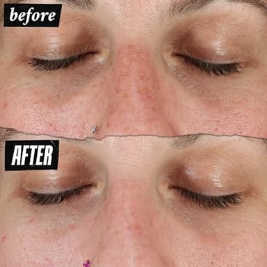 Kiehl's Clearly Corrective Dark Spot Serum, Brightening Facial Serum, Reduces Hyperpigmentation & Post-acne Marks, with Vitamin C & Salicylic Acid, All Skin Types, Paraben-free - 3.4 fl oz - Image 5