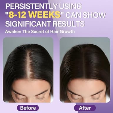 5% Minoxidil Foam for Women Hair Growth Foam Suitable for Hair Thinning Receding Hairline and Hair Loss - Image 4