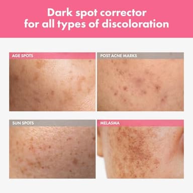 TOSOWOONG Arbutin 7% Intensive Spot Cream with 70,000ppm Arbutin, 3% Tranexamic Acid, 1% Niacinamide, Glutathione, Dark Spots, freckle, Blemishes, Anti-pigmentation, Korean Skin Care, 20ml, 0.67 fl.oz - Image 2