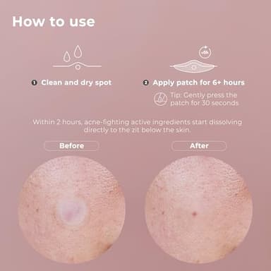 OMMA Korean Microdart Acne Patch, Cystic Acne Treatment, Micropoint Pimple Patches for Face for Early-Stage Painful Zits, Salicylic Acid & Tea Tree - 14 mm Zit Stickers (18 Count) - Image 6