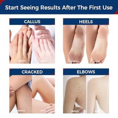 OUKEYA Urea Cream 42 Percent with 2% Salicylic Acid Tube 3 Oz, Urea Foot & Hand Cream for Dry Cracked, 40 per Urea Lotion for Feet Maximum Strength - Image 5