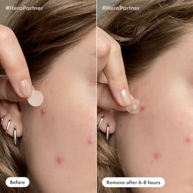 Mighty Patch™ Day and Night Patches – The Hydrocolloid Patch Duo Pack. Derm-Tested. Medical-Grade Hydrocolloid. Absorbs Pimple Gunk in 6-8 Hours. 36ct (18x Original, 18x Invisible+) - Image 5