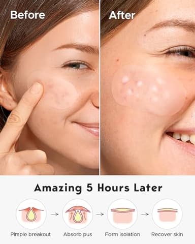 LitBear Large Acne Pimple Patches, 5 Sizes 80 Patches for Large Breakouts, Acne Patches for Face, Chin or Body, Acne Spot Patch with Tea Tree & Calendula Oil, Hydrocolloid Bandages for Acne Skin - Image 6