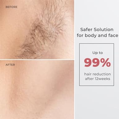 Laser Hair Removal for Women and Men, IPL with Ice-Cooling System for Nearly Painless And Long-Lasting Result At-Home Permanent Hair Removal Device 999999 Flashes for Whole Body Use - Image 2
